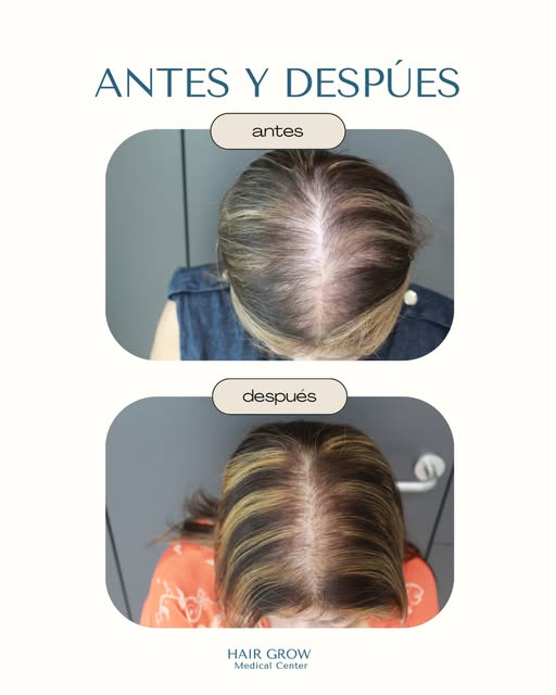 Resultados desde el tercer mes tanto en mujeres como en hombres. Las mujeres también pueden sufrir d