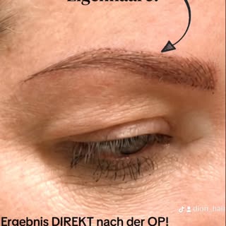 Wir sind nach unserem Kenntnisstand die einzige Klinik in Deutschland, die Long Hair FUE-Augenbrauen