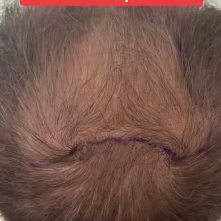 #haartransplantation #mönchengladbach #hairtransformation #haircut #hairstyle Hair Engineering auf h