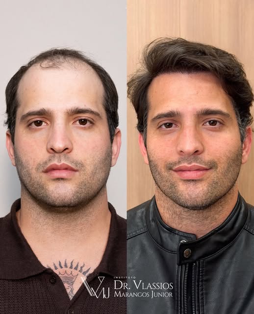 Esse é o resultado incrível do transplante capilar do @iansteffans_ 

-

✅ Esta publicação é de natu