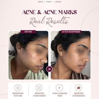 Real skin, real transformation! ✨ Notice smoother texture, reduced acne marks and more even-looking 