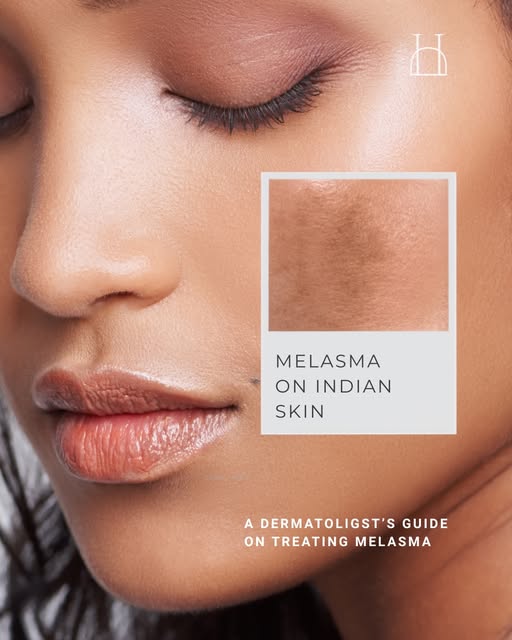 A dermatologist guide on treating Melasma.

#melasma #melasmatriggers #treatment #dermatologist #drm