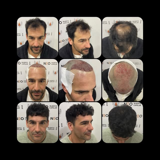 Coleccionando éxitos.

Injerto capilar para reconstrucción de coronilla y restauración de primera lí
