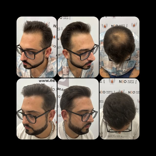 Coleccionando éxitos.

Trasplante capilar de restauración de primera línea frontal, más entradas lat