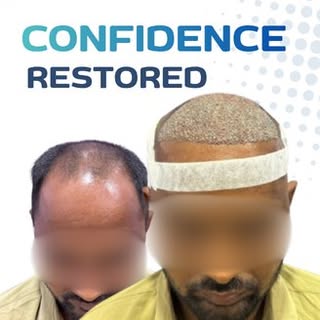 🚨 Hair loss isn't the end of your story... It's the beginning of your Hair Restoration journey. 🌱✨