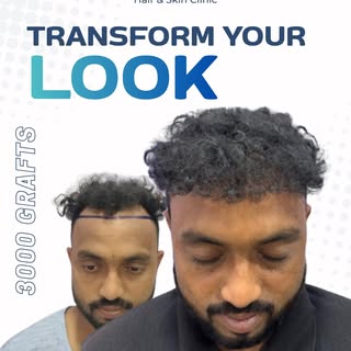 🚨 Real Results. Real Confidence. Real Hair Transformation. 🔥

This Hair Transplant Result is more 