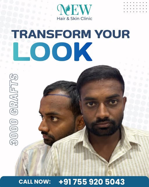 ✨ Sometimes, one decision is all it takes to change your confidence. 💯

This real Hair Transplant R