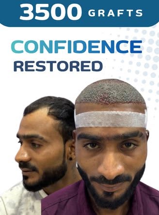 🔥 Hair loss is not just about losing hair — it can affect your confidence too. 👀✨

Your Hair Resto