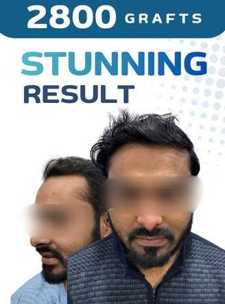 🔥 From hair loss to a natural-looking hairline — watch the transformation till the end! 👀✨

This r