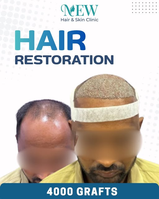 🔥 Hair loss is not just about losing hair — it’s about losing confidence too.

Hair Restoration is 