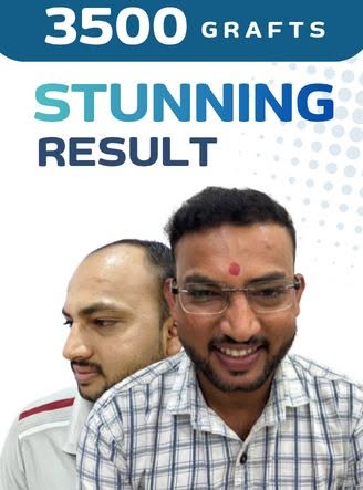 🔥 From Hair Loss to a Natural-Looking Hairline — Watch This Real Hair Transplant Transformation! 👀