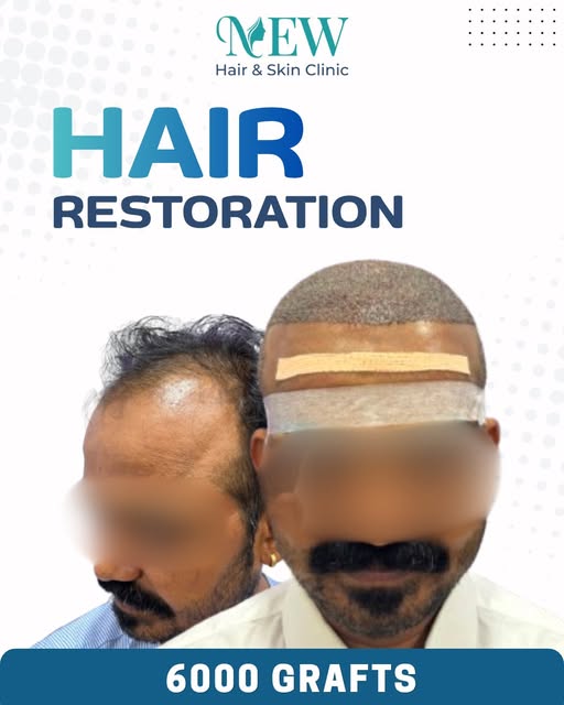 🔥 Hair loss today doesn’t have to define your tomorrow. Your Hair Restoration journey starts with t