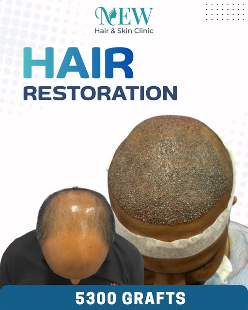🔥 Hair Restoration is not just about treating hair loss — it’s about restoring confidence.

Hair fa