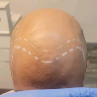 Norwood 7, Trust the process! Session 2 of 3.

Bald and want a natural looking hairline to frame you