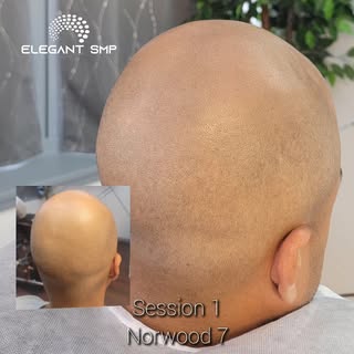 Session 1 in the bag. Easy does it, 3 sessions to complete.

---

On the fence about getting scalp m