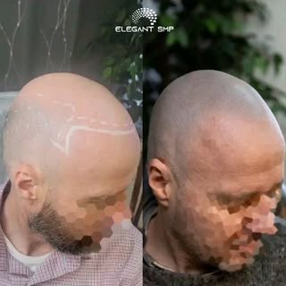 Bald and want a natural looking hairline?

Consider scalp micropigmentation at Elegant SMP.

Located