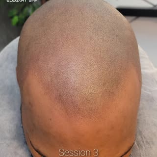 We seek and destroy bald spots! We're located in Orchard Park, NY. Reach out to us for a free 30-min