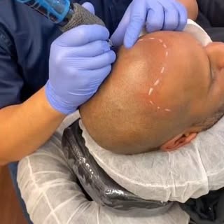 Say goodbye to balding!

Send over photos of your head for a quote of our premium SMP services.

50%