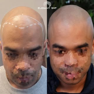 Client wanted a more subtle approach to his SMP and so we kept his hairline soft with a frame that c