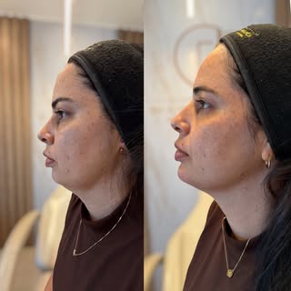 ✨ Pequenas mudanças, grandes impactos.

Essa paciente chegou à clínica acreditando que precisava de 