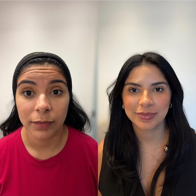 Ela chegou com um medo muito comum: “Dra., eu tenho medo de ficar artificial.” 🥹

Essa paciente nun