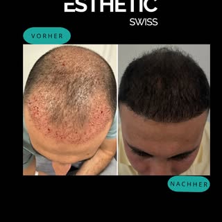 ✨ Plasmatherapie (PRP): Vorher ➡️ Nachher ✨

Mehr Dichte, stärkere Haare und eine klar definierte Ha