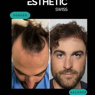 Präzise FUE- Haartransplantation:
Auffüllung der Geheimratsecken + natürliche Verdichtung für eine h
