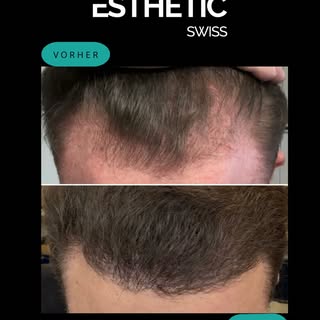 Mit einer individuell geplanten Haartransplantation können lichte Stellen dauerhaft aufgefüllt und d