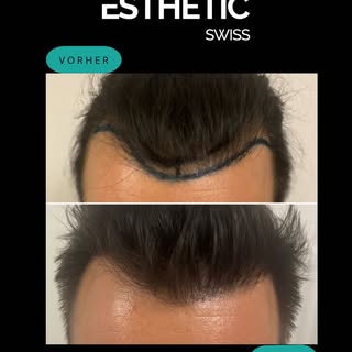 Jede Haartransplantation wird individuell geplant. Dieses Ergebnis zeigt die natürliche Rekonstrukti