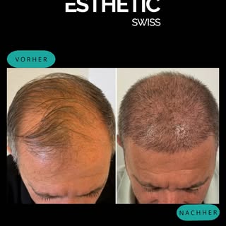 Sichtbar mehr Haardichte – Höchste Präzision bei Esthetic Swiss Klinik. 

Erhalten Sie Ihre kostenlo