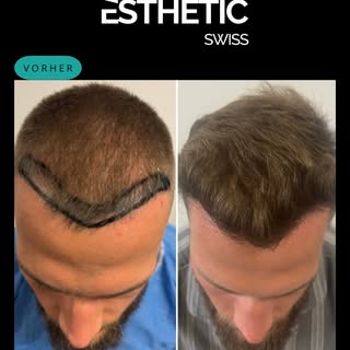 Eine erfolgreiche Haartransplantation beginnt mit Präzision!✨

Nicht nur eine natürliche Haarlinie e