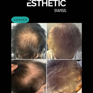 7 Monate nach FUE-Haartransplantation✨

Haartransplantationen sind nicht nur für Männer geeignet. Au