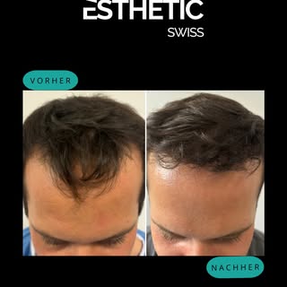 9 Monate nach FUE-Haartransplantation: Natürliches Ergebnis, neues Selbstbewusstsein.✨

Die Geheimra