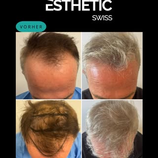 9 Monate nach der FUE-Haartransplantation✨

✔️ Die Haarlinie wurde altersgerecht und harmonisch reko