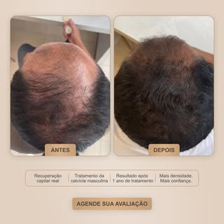 Esse paciente chegou ao consultório com alopecia androgenética, a calvície masculina mais comum.

An