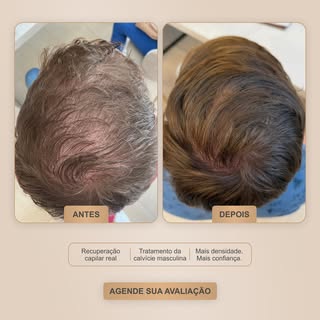 A alopecia androgenética pode começar muito antes dos 30. E quanto mais cedo o tratamento começa, ma