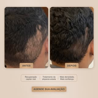 Nem toda queda de cabelo é igual. E esse caso deixou isso muito claro.

A alopecia areata é uma doen