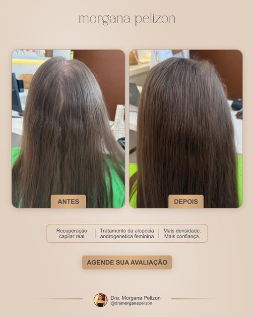 A perda de densidade capilar nem sempre começa com falhas visíveis.

Muitas vezes, os fios vão fican