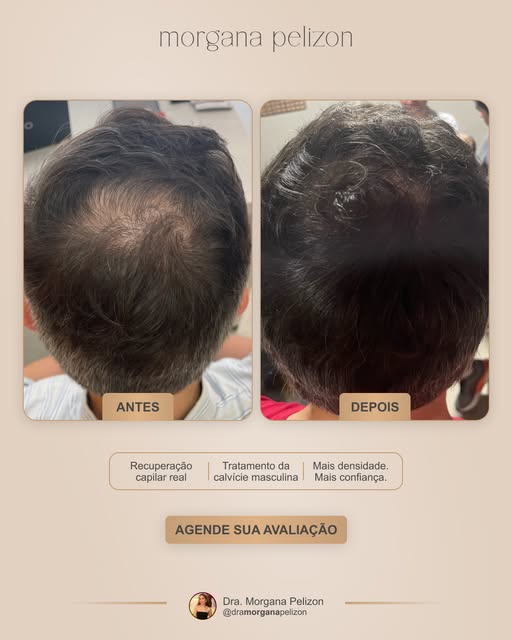 A calvície raramente aparece de uma vez.

Na maioria das vezes, ela avança aos poucos. E quando perc