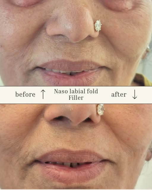 ✨️ Dont shy away from treating yourself with some self care. Dermal fillers are just the thing when 