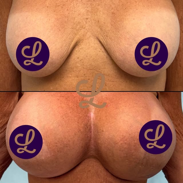 Go big? Mission accomplished ✨

This patient wanted an XL augmentation, and Dr. Lewis delivered with