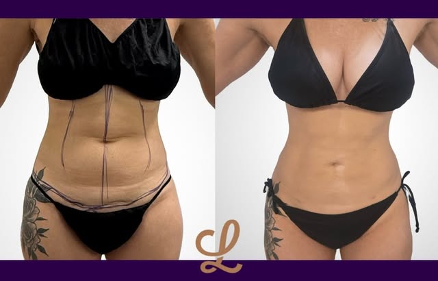 A transformation from every angle.

This patient underwent Liposuction 360, targeting the full abdom
