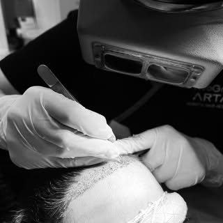 FUE restoration of previously lasered frontal hairline with @emily.s.w92 #fuehairrestoration @flawle