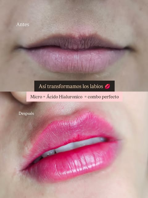 Cuando combinamos Micro + Ácido hialurónico, en los labios  podemos potenciar su belleza de forma pe