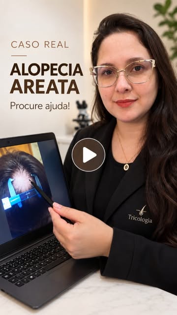 ⚠️ Falhas no cabelo podem ser sinal de Alopecia Areata.

A Alopecia Areata é uma condição que pode c