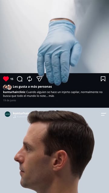 Recuperar pelo es solo una parte.
El verdadero objetivo de un injerto capilar es conseguir un result