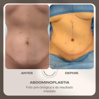 Abdominoplastia clássica para melhorar flacidez e contorno corporal 😍.

Se você ficou com alguma dú