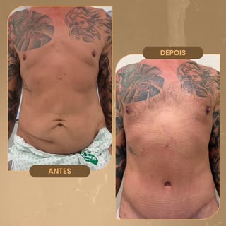Abdominioplastia masculina em paciente bariátrico que passou por expressiva perda de peso. Além da f