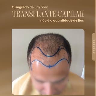 Um transplante capilar não consiste apenas em transferir fios de uma região para outra... 🧐

O suce