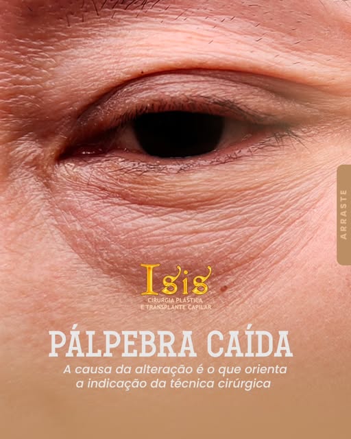 A aparência de pálpebras caídas pode ter diferentes causas, e identificá-las é fundamental para defi